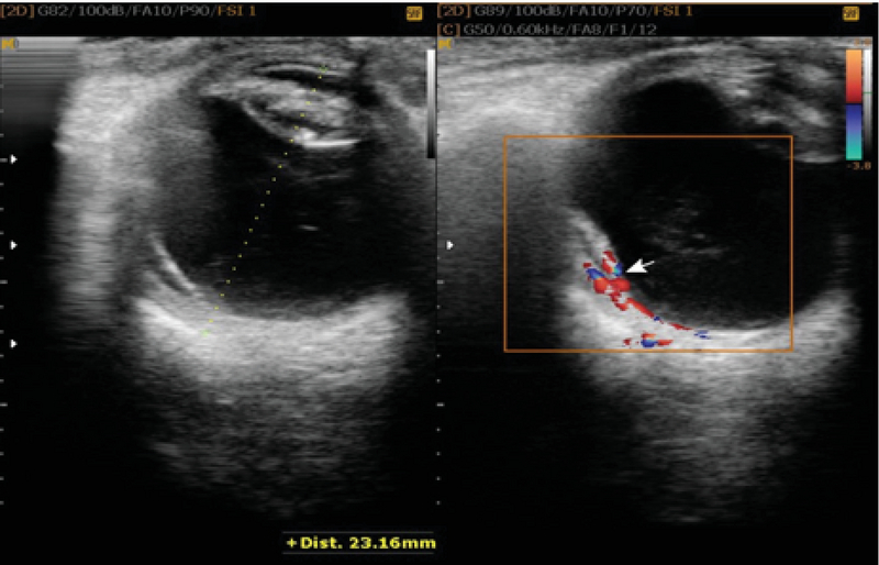 vitreous detachment ultrasound