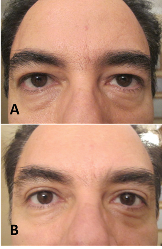 Techniques Of Eyebrow Lifting A Narrative Review Journal Of Ophthalmic And Vision Research Jovr