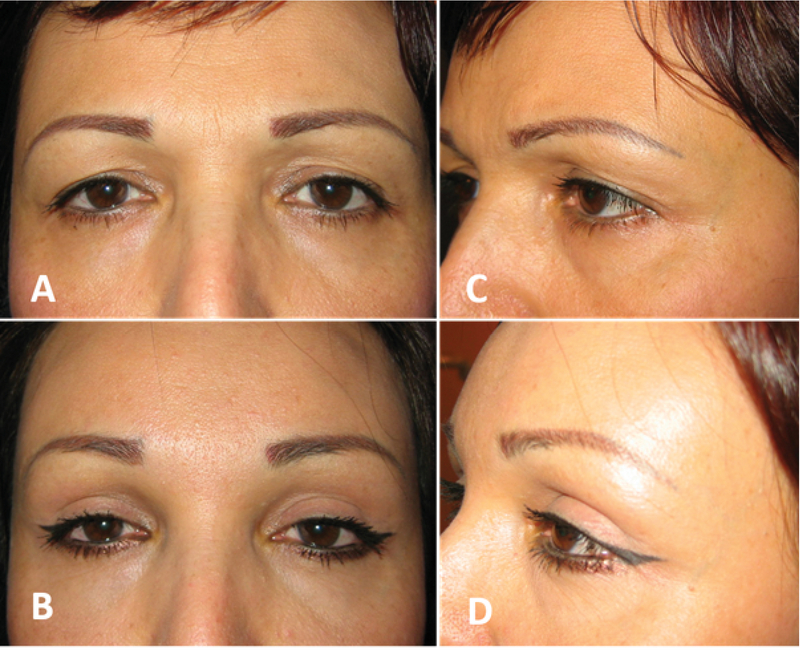 Techniques Of Eyebrow Lifting A Narrative Review Journal Of Ophthalmic And Vision Research Jovr