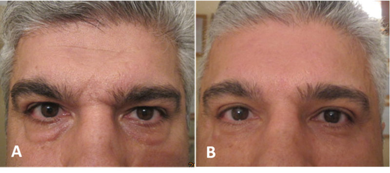 Techniques Of Eyebrow Lifting A Narrative Review Journal Of Ophthalmic And Vision Research Jovr