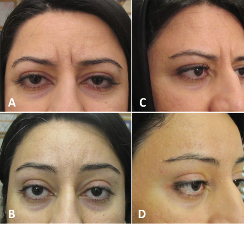 Techniques Of Eyebrow Lifting A Narrative Review Journal Of Ophthalmic And Vision Research Jovr