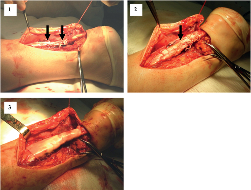 Plastic Reconstruction Of Dehenerative Achilles Tendon Ruptures Using The Bioprosthesis Of Xenopericardium Kne Energy