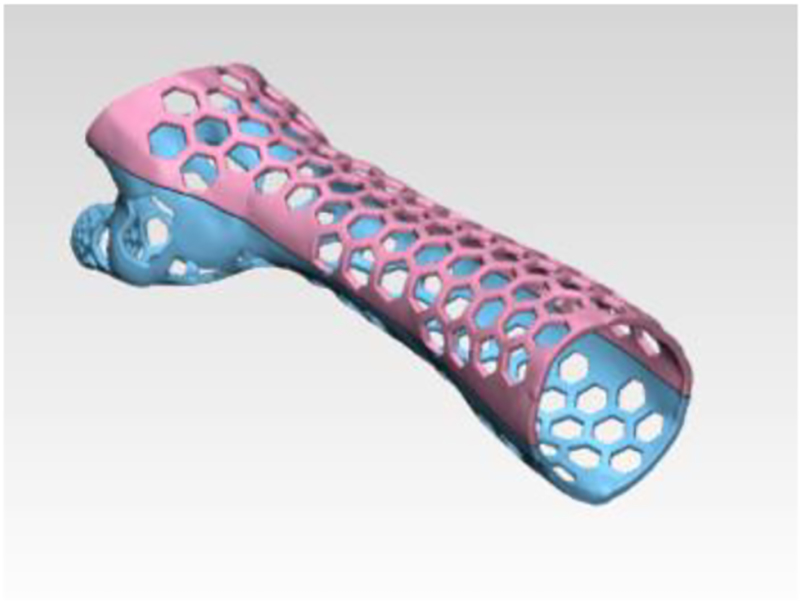 Design of a Patient Specific, 3D printed Arm Cast P Fitzpatrick KnE