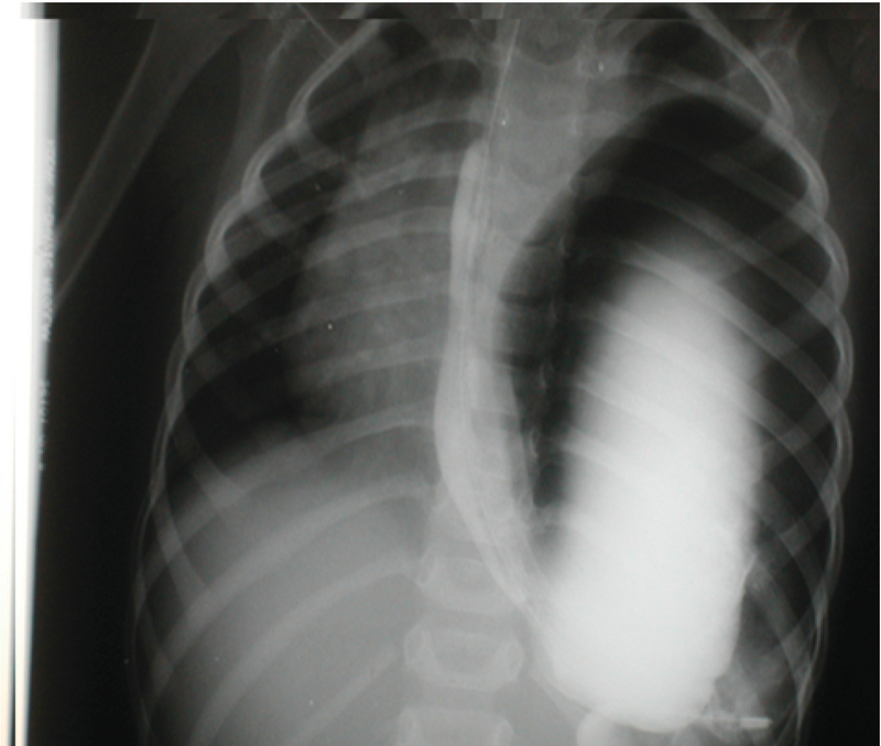 traumatic diaphragmatic hernia