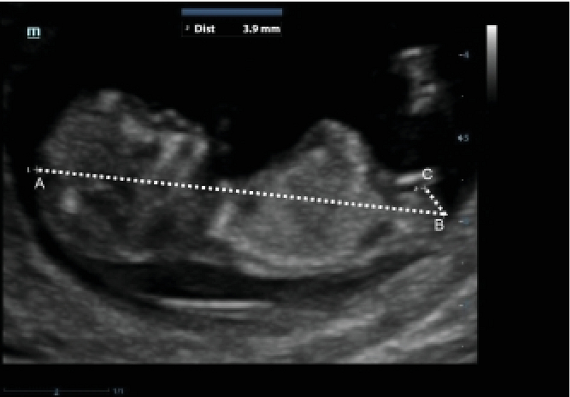 First Trimester Determination Of Fetal Gender By Ultrasonographic Measurement Of Anogenital Distance A Cross Sectional Study International Journal Of Reproductive Biomedicine Ijrm